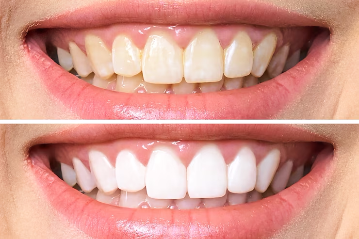 dentes-antes-e-depois-do-clareamento_168410-587-1
