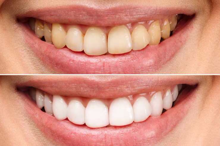 dentes-da-mulher-antes-e-depois-do-clareamento-sobre-fundo-branco_168410-1693-1